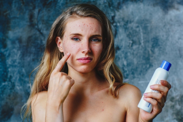 Akne ravi: probleemse naha hooldusvõtted, mis tõesti toimivad