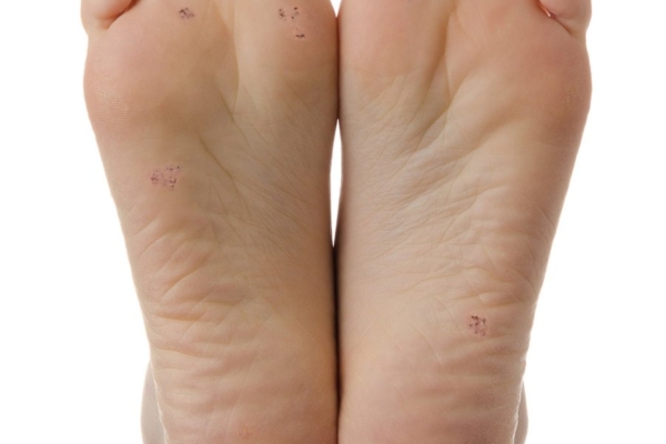 Tõhusad kodused vahendid soolatüügaste eemaldamiseks